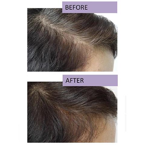 Image 1 - A side-by-side comparison of a persons hair before and after treatment, with the word BEFORE above the first image and AFTER above the second image, showing noticeable improvement in hair thickness and coverage.
Image 2 - Image shows two side-by-side photos of a persons hairline, with the top photo labeled Before showing thinning hair, and the bottom photo labeled After showing a fuller hairline.
Image 3 - A woman with long dark hair and a pearl necklace is smiling, next to a purple watercolor background featuring the text, GETTING PERSONAL As someone who has struggled with fine, thin hair most of my life, I have tried several volumizing products. While some give a temporary fix, I have never found a product like RapidHair. After the first few nights of using it, I found my hair had volume without the constant fighting, teasing, and use of hairspray.