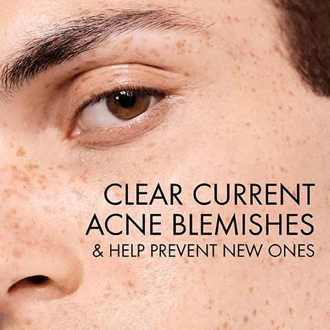 Image 1 - Close-up of a face showing freckles and clear skin around a brown eye with visible text reading CLEAR CURRENT ACNE BLEMISHES & HELP PREVENT NEW ONES.
Image 2 - Close-up of a womans face showing her clear skin, with text stating benefits of a skincare product: AFTER FIRST WASH: Excess shine appears reduced, AFTER 1 WEEK: Skin looks clearer, AFTER 4 WEEKS*: Visibly reduced acne blemishes, pores and blackheads.
Image 3 - A split image shows a green background on the left with the text 0.5% SALICYLIC ACID and GENTLY EXFOLIATES SKIN, while the right side features a blue background with the text MINERAL RICH VICHY VOLCANIC WATER and STRENGTHENS & REPAIRS SKIN BARRIER.
Image 4 - A hand is shown with a translucent gel on the skin, and a finger is pressing the gel, which has text that reads, Translucent gel lathers quickly into a foam that rinses easily.
Image 5 - A person in a white lab coat holds a green tube of Vichy Normaderm Daily Deep Cleansing Gel, surrounded by icons indicating it is sensitive skin tested, allergy tested, paraben free, and dermatologist and ophthalmologist tested.