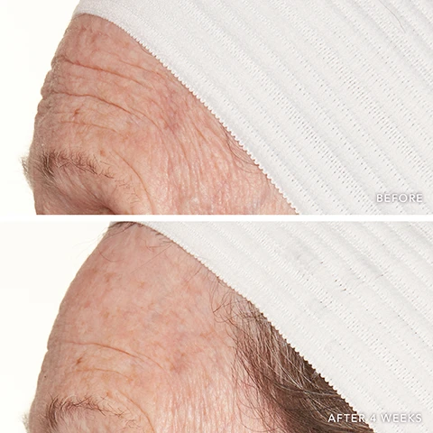Image 1 - A split image showing a before and after comparison of a persons forehead with a white headband, where the top section shows deep wrinkles and the text BEFORE, and the bottom section shows visibly reduced wrinkles and the text AFTER 4 WEEKS. Image 2 - The image shows a split comparison of skin, with the left side depicting a before image with more visible wrinkles and pores, and the right side showing an after image with smoother skin and less prominent wrinkles and pores; the labels read BEFORE and AFTER 4 WEEKS. Image 3 - A before and after comparison image shows a close-up of skin, with the top panel displaying deep wrinkles next to the text BEFORE, and the bottom panel showing significantly smoother skin next to the text AFTER 4 WEEKS.