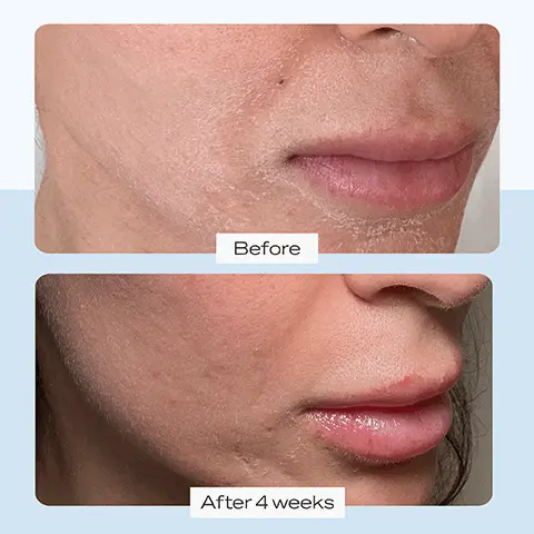 Before. After 4 weeks. Starts working immediately to strengthen the skin barrier.