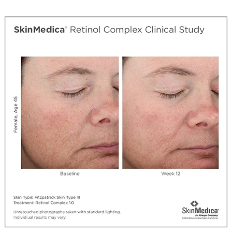 Image 1 - Two side-by-side photographs of a 45-year-old woman showing her face at baseline and after 12 weeks of treatment, with visible text including Baseline and Week 12, along with details about skin type and treatment.
Image 2 - Image of SkinMedica skincare products arranged in a line, including an AHA/BHA Exfoliating Cleanser, TNS Advanced+ Serum, Retinol, HA+ Hydra Collagen Hydrator, and Essential Defense Mineral Shield Sunscreen, with the text Complete Your SkinMedica® Method Routine at the top.