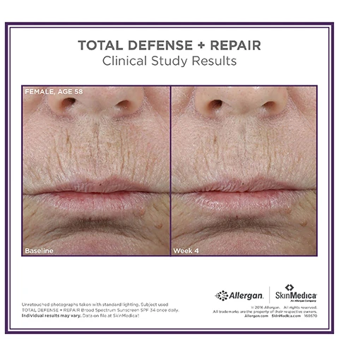 Image 1 - Image showing two close-up photographs of a females face, aged 58, displaying wrinkle reduction; the left side labeled Baseline shows more pronounced wrinkles, while the right side labeled Week 4 shows a smoother appearance. Visible text includes Total Defense + Repair, Clinical Study Results, Female, Age 58, Baseline, Week 4, and a disclaimer about individual results.
Image 2 - Before and after images showing the skin around the eyes of a 63-year-old female, with the left side labeled Baseline and the right side labeled Week 12, demonstrating the effects of a skincare product.
Image 3 - Image shows a collection of SkinMedica skin care products arranged from left to right, including AHA/BHA Exfoliating Cleanser, TNS Recovery Complex, TNS Eye Repair, Dermal Repair Cream, and Total Defense + Repair Broad Spectrum SPF 34 sunscreen, with the text Complete Your SkinMedica® Method Routine at the top and numbered steps for each product.