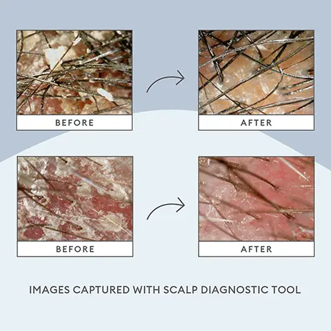 Image 1, before and after, images captured with scalp diagnostic tool. Image 2, before and after, hair not retouched. to achieve this look use: scalp revival collection = charcoal plus coconut oil micro exfoliating shampoo, charcoal plus tea tree cooling hydration scalp mask and charcoal plus tea tree scalp treatment. Image 3, clinically shown scalp care, reduces 82% dry scalp flaking. increase scalp hydration up to 120% *clinical study using skin hydration measurement instrumentation. Image 4, scalp revival collection, clinically proven to increase scalp hydration