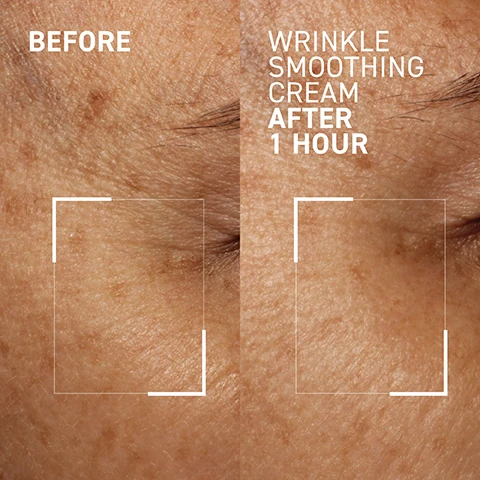 Image 1, before and 1 hour after wrinkle smoothing cream. image 2, 100% reported skin around the eyes has a more lifted appearance after 15 minutes. instrumental evaluation conducted on 39 volunteers. image 3, invented by the baron of botox. reduces the appearance of expression lines. help stimulate collagen. firms and protects the skin. image 4, target your ideal without the needle. 100% reported visibly improved expression lines after 2 weeks. clinical study conducted on 25 volunteers, volunteers satisfaction results after use of product AM and PM for 4 weeks. image 5, synthetic fragrance free, sulfate free, paraben free, cruelty free. step 1 = cleanse, step 2 = exfoliate, step 3 = treat, step 4 = moisturise, step 5 = protect. how: apply on clean skin, pat on areas of concern - forehead, frown lines and crow's feet. when: daily AM or PM