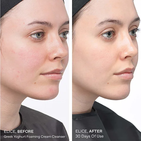 Image shows a side-by-side comparison of a woman’s face before and after using a skincare product; left side labeled ELICE, BEFORE with visible redness and blemishes, and right side labeled ELICE, AFTER showing clearer skin after 30 days of use.