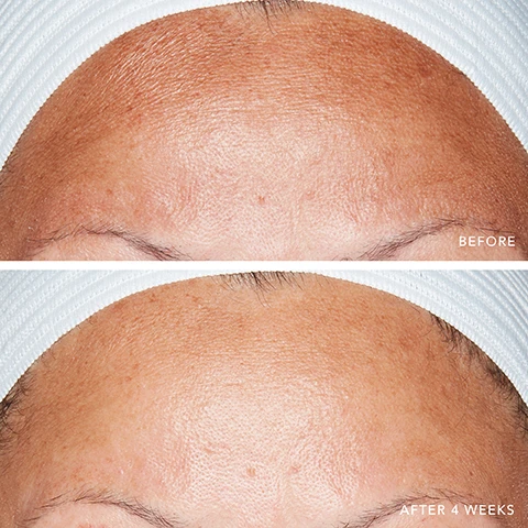 Image 1 - A two-panel image shows a forehead before and after treatment, with the top panel displaying skin with visible fine lines and texture labeled BEFORE, and the bottom panel showing smoother skin with reduced lines labeled AFTER 4 WEEKS. Image 2 - A close-up split image compares skin texture, showing more prominent pores and some redness on the left, and smoother skin with less visible pores and more even tone on the right, labeled BEFORE and AFTER 4 WEEKS. Image 3 - A before and after comparison showing a persons forehead with visible wrinkles and lines in the top image marked BEFORE, and a smoother forehead with reduced wrinkles in the bottom image marked AFTER 4 WEEKS. Image 4 - A before and after comparison showing an aged neck with visible wrinkles and lines, labeled BEFORE, contrasted with the same neck after 4 weeks, labeled AFTER 4 WEEKS, which appears to have slightly less prominent wrinkles. Image 5 - A before and after comparison of a forehead, with the top image showing more visible sun damage and fine lines, and the bottom image after 4 weeks showing lighter spots and smoother skin, with the text BEFORE and AFTER 4 WEEKS.