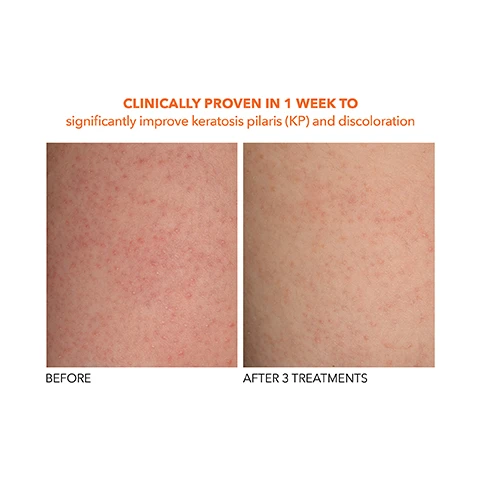 Image 1 - Image showing a side-by-side comparison of skin on a leg before and after treatment for keratosis pilaris, with visible text indicating clinically proven results and the labels BEFORE and AFTER 3 TREATMENTS.
Image 2 - Before and after images show skin texture improvements, with the left side labeled BEFORE and the right side labeled AFTER 3 TREATMENTS, accompanied by the text CLINICALLY PROVEN IN 1 WEEK TO significantly improve keratosis pilaris (KP).
Image 3 - Image showing two close-up photos of skin with acne, the top image labeled BEFORE showing visible breakouts, and the bottom image labeled AFTER 3 TREATMENTS displaying smoother skin with fewer breakouts, accompanied by the text CLINICALLY PROVEN: 100% of subjects showed significant reduction in breakouts in 1 week.