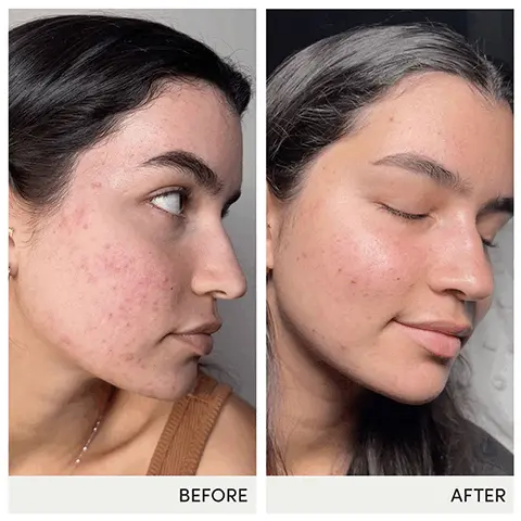 Image 1, BEFOREAFTER Image 2, Skin AccumaxTMMRecommended for problem skinContains vitamin A, C, E and phytonutrientsSupports all areas of the body including back and shouldersClarifies complexionFree fromharsh chemicals Image 3, OBEFOREAFTER Image 4, BEFOREAFTER