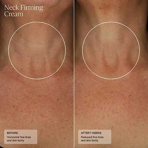 neck firming cream before horizontal fine lines and skin laxity and after 7 weeks, reduced fine lines and skin laxity.