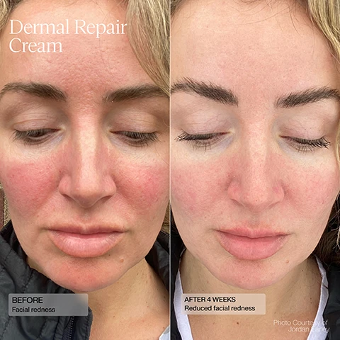 Image 1, dermal repair cream. before with facial redness. after 4 weeks, reduced facial redness. image 2, dermal repair cream. before, facial redness. after 12 weeks - reduced facial redness. image 3, dermal repair cream. before fine lines. after 2 weeks, reduced fine lines. image 4, dermal repair cream. before - uneven skin tones. after 2 weeks - more even looking skin tone.