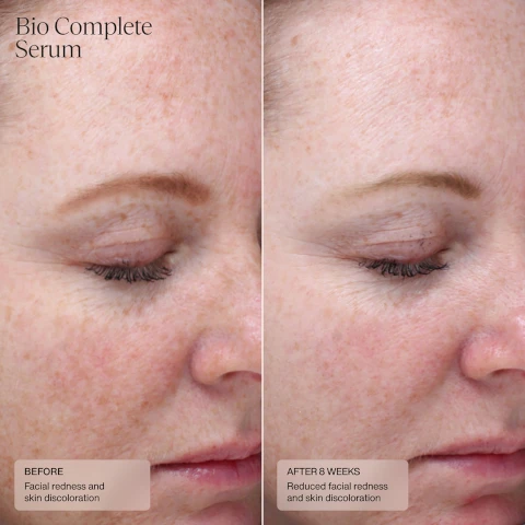 Image 1, bio complete serum, before - facial redness and skin discoloration. after 8 weeks - reduced facial redness and skin discoloration. image 2, bio complete serum and dermal repair cream. before - skin dryness and facial redness. after 4 weeks - reduced dryness and facial redness.