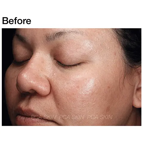 Image 1, Before and After model shot. Image 2, A compete at home kit, facial wash that gently removes impurities, hydrating toner that boosts skin hydration, Detoxifying mask, absorbs oil and impurities, enzymatic treatment, reveals bright, strengthened skin, rejuvenating serum helps prevent signs of aging, rebalance calms and soothes skin, daily defense broad spectrum 50+ defends against UVA/UVB rays. Image 3, Differences you can see, before and after immediate tretament