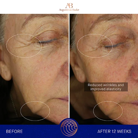 Image 1, before and after 12 weeks