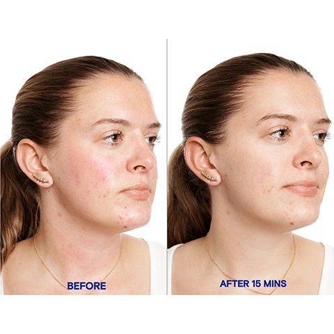 Image 1 - A split image shows a womans profile, on the left her face has redness and blemishes and is labeled BEFORE, on the right her skin appears clearer with reduced redness and is labeled AFTER 15 MINS. Image 2 - A woman with her eyes closed has white cream applied to her cheek, while she holds an open jar of face mask, with text that reads KORRES Greek Yoghurt Probiotic SuperDose Face Mask, Full skin reset, full skin benefits: Recovers + rebalances skin, Replenishes with intense hydration, Reduces redness. Image 3 - A white jar of Korres Hydra-Biome probiotic superdose face cream with a creamy texture visible inside, accompanied by text stating product benefits: KORRES 97% saw glowing, radiant skin right after use, 100% saw nourished, healthy-looking, balanced skin right after use, 97% saw softer, smoother, more hydrated skin right after use, EST KORRES HYDRA-BIOME PROBIOTIC SUPERDOSE FACE CREAM WITH REAL GREEK YOGURT NET WT. 1.35 FL. OZ. U.S. / 100 mL e Manufactured for KORRES USA INC. New York, NY 10014 Made in Greece.