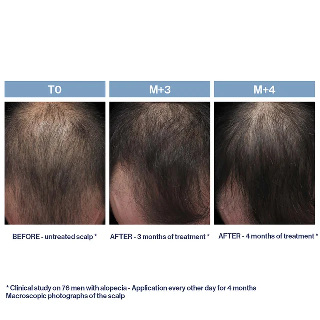Before and After