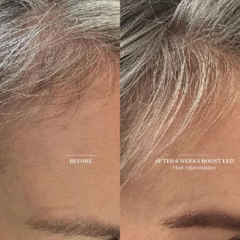 image 1, before and after 6 weeks boost LED - hair rejuvenation. image 2, before and after 8 weeks boost LED - hair rejuvenation. image 3, before and after 8 weeks boost LED - reduced skin sensitivity. image 4, how is it different to other boost devices? the patch's size, shape and straps are designed to be easily applied from heat to toe, wherever you need it most. this device also emits a soothing warmth to deepen your relaxation. does it require any prep? for the patch to work effectively it should be used on clean skin. we recommend using our boost enzymatic cleanser, which smooths and hydrates the skin for even light absorption. if using on the hair, ensure it's clean and dry with minimal product as too much product as too much product or oil will impede the absorption of light. image 5, boost LED patch, head to toe rejuvenation. what does it do? in addition to treating the skin, the patch can be used to target a range of concerns, including spots injury, hair loss, menstrual pain, menopausal symptoms, stress, anxiety and sleeplessness.