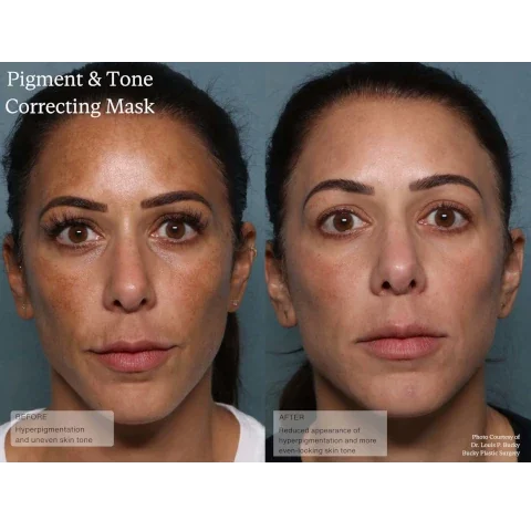 pigment and tone correcting mask. before - hyperpigmentation and uneven skin. after - reduced appearance of hyperpigmentation and more even looking skin tone.