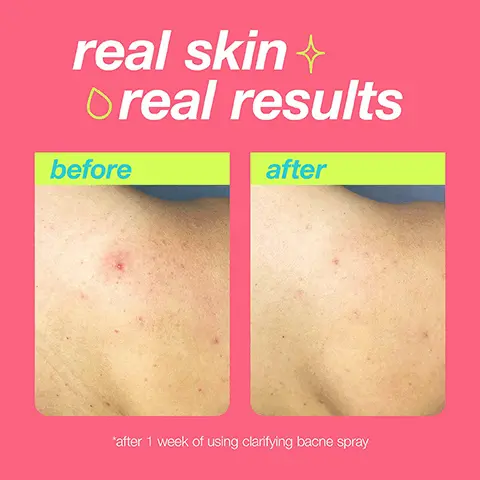 real skin, real results. before, after, after 1 week of using clarifying bacne spray. salicylic acid exfoliates to prevent breakouts. moroccan argan oil balances excess oil + redness. witch hazel & teat tree oil soothes, revives, + cools skin. clears skin + prevents new breakouts. 360-degree continuous spray targets hard-to-reach areas. refreshing citrus scent.