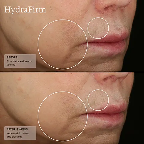 image 1, hydra firm, before - fine lines, skin laxity, loss of volume. after 12 weeks - reduced fine lines, improved firmness and elasticity. Image 2, hydra firm, before - skin laxity and loss of volume. after 12 weeks - improved firmness and elasticity.