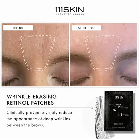 Image 1, 111SKIN HARLEY ST. LONDON CLINICALLY PROVEN TO: Reduce deep eye wrinkles by 23% after one use.* Reduce deep smile lines by 17% after one use.** Reduce deep wrinkles between the brows by 22% after 4 weeks.*** *Based on the results of a clinical study on 20 participants, skin absorption speed and depth improved by +258%, compared to a reference essence product with same ingredients **Based on the results of a clinical study on 21 participants, using Antera 3D to evaluate wrinkles after a single use ***Based on the results of a clinical study on 21 participants, using Antera 3D to evaluate wrinkles after using the product every 2 days for 4 weeks. Image 2, BEFORE 111SKIN HARLEY ST. LONDON WRINKLE ERASING RETINOL PATCHES Clinically proven to visibly reduce the appearance of deep wrinkles between the brows. AFTER 1 USE 111SKIN
