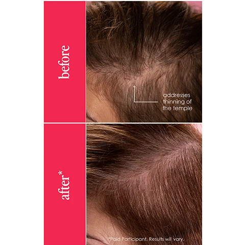 Image 1 - Image showing a side-by-side comparison of hair appearance before and after treatment, with the word before on the top left and after on the bottom left; additional text labeled addresses thinning of the temple is displayed next to the before image, and a footnote indicating Paid Participant. Results will vary is noted below the after image.
Image 2 - A woman with long brown hair holds a hair serum bottle, smiling at the camera, with the text 8 weeks healthier, thicker looking hair* 97% saw improved hair thickness + less hair thinning* in the background.
Image 3 - A hand holding a dropper bottle of Grande Hair Hair Enhancing Serum is shown against a pink background, with quotes from InStyle and Bazaar highlighting the products benefits regarding hair thinning and scalp health.
Image 4 - A person is holding a dropper above a sectioned area of their scalp, with instructions visible in red bubbles that say section the hair to expose areas that are thinning, use dropper to apply directly to scalp 1x daily, and massage in with fingertips + let serum absorb.
Image 5 - A person holding a bottle of Grande Hair Enhancing Serum with curly hair in the background, featuring text that reads it actually works and a customer testimonial stating Ive been using this for 2 months and I cant believe the results. Its like GrandeLASH-MD, but for your hair.
