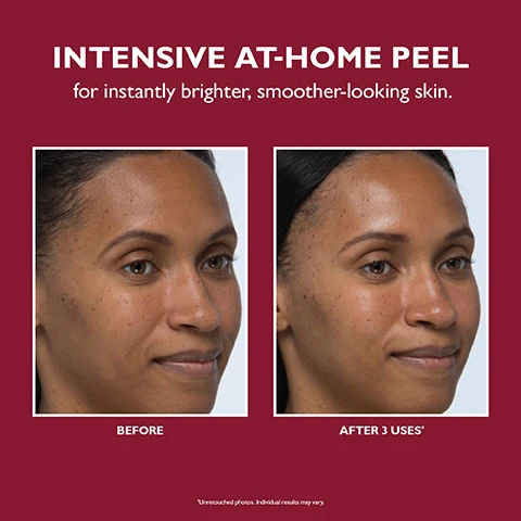 Image 1, intensive at home peel for instantly brighter, smoother looking skin. before and after 3 uses. image 2, 30% glycolic acid solution provide intensive exfoliation for expert level smoothing results. niacinamide helps brighten and improve the look of uneven tone. hyaluronic acid and hydrolized collagen leaves skin feeling soft and balanced. image 3, instantly and over time skin appears brighter, smooth and clear. image 4, pre soaked for easy at home application. image 5, how to apply. step 1 = swipe peel soaked swab onto cleansed face. step 2 = leave peel on no longer than 10 minutes. step 3 = rinse with water to neutralise peel.