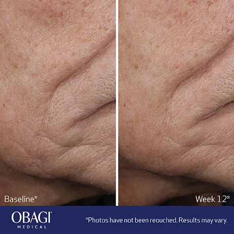 Baseline* OBAGI MEDICAL Week 12* *Photos have not been reouched. Results may vary.