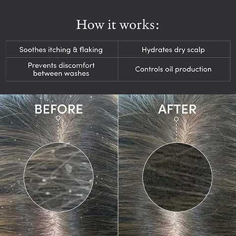 Image 1, how it works - soothes itching and flaking. hydrates dry scap. prevents discomfort between washes. control oil production. image 2, zinc pyritione - medicated active ingredient scientifically proven to treat dandruff. aloe vera juice - helps soothe dry, itchy scalps and naturally prevent greasiness. niacinamide - helps control oil and reduces excess sebum production. pea protein - protects and restores damaged hair, reducing breakage. image 4, Drug Facts Active Ingredient Zinc Pyrithione 0.125% Purpose Dandruff control Use(s) For the relief of symptoms from scalp itch, flaking, irritation, and redness associated with dandruff. Warnings For external use only. Avoid contact with eyes. If contact occurs rinse eyes thoroughly with water. If condition worsens or does not improve after regular use of this product as directed, consult a doctor. Keep out of reach of children. If swallowed, call a poison control center or get medical help right away. Do not use on children under 2 years of age, unless directed by a doctor. Directions Apply to affected areas 1-to-4 times daily or as directed by a doctor. Apply liberally to damp or dry scalp, and gently massage with fingertips. Do not rinse off. Made in the USA Dermatologist Tested 100% Vegan Beauty Award Winner Women's Health Leaping Bunny Certified Safe for Color-Treated Hair