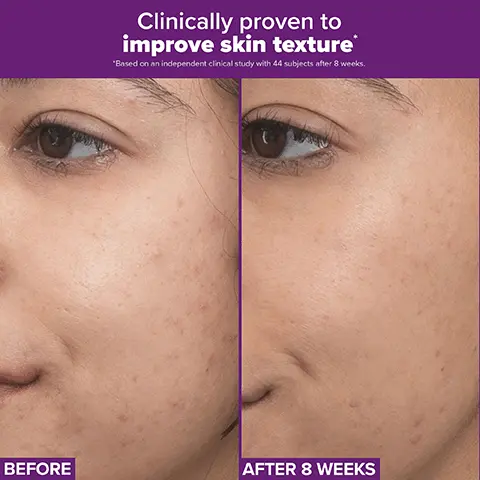 Image 1 - Image showing a comparison of a persons face with visible skin texture issues on the left labeled BEFORE and smoother skin after treatment on the right labeled AFTER 8 WEEKS, with the text Clinically proven to improve skin texture at the top.
Image 2 - Image shows three close-up photos of a forehead with varying degrees of wrinkle reduction; the top photo labeled Before, the middle photo labeled After 2 Weeks, and the bottom photo labeled After 8 Weeks, with text stating Clinically proven results in 2 weeks with minimal irritation.
Image 3 - A close-up image of a bottle of Paulas Choice skincare product with a yellow cream swirl on the side, featuring text that reads PAULAS CHOICE, NATURAL BIOACTIVE YELLOW, and Retinaldehyde has a naturally vibrant hue.
Image 4 - Abstract purple and yellow image with text stating 94% agree feels gentle on skin and 100% had improved luminosity & texture, followed by a small note about the studies conducted.
Image 5 - Diagram illustrating a high potency, gentle release formula featuring encapsulated retinaldehyde to minimize irritation while delivering derm-level results, accompanied by the text: Retinaldehyde is calcium-encapsulated to minimize irritation while delivering derm-level results. Encapsulated retinaldehyde. Gentle, time-released delivery.
Image 6 - Image of a cosmetic product labeled Paul A. Skin Concerns with a yellow product swirl next to icons representing skin issues: Dullness, Texture, Breakout-Prone, and Uneven Tone.
Image 7 - A hand is shown holding a small amount of yellow cream from a purple tube, with text explaining the two key ingredients: Retinaldehyde, described as closest to prescription-strength retinoid for minimal irritation, and Adapinoid, noted as an oil-soluble retinoid that promotes clear skin.
Image 8 - A hand holds a pump bottle of Paulas Choice Pro Retinaldehyde Dual-Retinoid Treatment with instructions on usage, including smoothing 1-2 pumps over face and neck, and starting 3 times a week.
Image 9 - Image shows two skincare products side by side: a black bottle labeled Exfoliate with the text BHA Unclogs Pores and a purple bottle labeled Clinical with the text PRO Retinaldehyde Delivers clear, luminous skin, accompanied by the phrase Treatments Work Harder With EXFOLIATION Pair together for clear, glowing skin. Image 10 - Image shows three bottles of Paulas Choice skincare products arranged in a row, labeled for different retinoid strength levels: Beginner with 0.3% Retinol, Intermediate with 1% Retinol, and Advanced with Pro Retinaldehyde, accompanied by bullet points stating Address early signs of aging, Tackle wrinkles + loss of firmness, and Get clear, luminous skin.