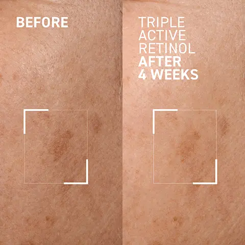 Image 1 - A side-by-side comparison of skin showing Before on the left with darker spots and TRIPLE ACTIVE RETINOL AFTER 4 WEEKS on the right displaying a clearer skin texture with fewer visible spots.
Image 2 - A woman with long, dark hair applies a cream to her cheek, with visible text stating 97% presented improvement in skin texture after 4 weeks of use* with a note below about evaluation details.
Image 3 - A small amount of creamy skincare product is displayed on a clear plate, with labels pointing to specific ingredients: Bakuchiol brightens skin tone while minimizing irritation, Encapsulated Retinol smooths the look of lines and wrinkles, and Pure Retinol immediately improves skin tone.
Image 4 - A woman holding a skincare product near her face is wearing a white shirt, with text on the side stating GET BRIGHT OVERNIGHT, Reduces the appearance of fine lines and wrinkles, Improves the appearance of discoloration, Helps promote skin renewal.
Image 5 - A sleek, white and yellow bottle of Dr. Brandt skincare product titled Triple Active Retinol is displayed against a light blue background, featuring text that reads DERMATOLOGIST TESTED, SYNTHETIC FRAGRANCE FREE, SULFATE FREE, PARABEN FREE, VEGAN, and RECYCLABLE.
