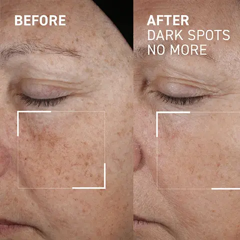 Image 1 - Image showing a close-up of a womans face with visible skin imperfections on the left labeled BEFORE and a smoother complexion on the right labeled AFTER DARK SPOTS NO MORE.
Image 2 - Image comparing skin texture before and after treatment showing a close-up of the same area of a face with visible improvement; left side labeled BEFORE and right side labeled AFTER DARK SPOTS NO MORE.
Image 3 - A white dropper bottle of Dr. Brandt skincare serum is centered against a background of yellow powder, with the text 82% showed a decrease in dark spot contrast* below the bottle, and *Instrumental evaluation conducted on 30 volunteers after 28 days.
Image 4 - A close-up image of a round, clear gel-like substance with visible bubbles on a white surface, labeled with text that reads TRIPLE ACIDS & NIACINAMIDES reduce number, intensity and size of pigmented spots and OXIBLOCK-SF® antioxidant-rich superfood complex boosts skins radiance, reduces hyperpigmentation & inflammation.
Image 5 - A woman with light brown hair applies a dropper of serum to her cheek, accompanied by text stating SEE SPOTS FADE, reduces the appearance of dark spots without causing white halos, evens skin tone & texture, targets dark spots, age spots, sunspots, melasma & post-acne marks.
Image 6 - Two women are posing for a photo; one is holding a skincare product while the other rests her head on the first womans shoulder; the image also features icons indicating the product is dermatologist tested, synthetic fragrance free, sulfate free, paraben free, vegan, and recyclable.