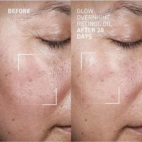 Image 1 - Side-by-side images of a woman’s face showing skin before and after using Glow Overnight Retinol Oil for 28 days, with the left labeled BEFORE and the right labeled AFTER 28 DAYS.
Image 2 - Image shows a close-up of a persons face split into two sections, the left labeled BEFORE showing uneven skin tone and the right labeled AFTER 28 DAYS with smoother skin texture, featuring text that reads GLOW OVERNIGHT RETINOL OIL.
Image 3 - A close-up profile of a person with dewy skin and a dropper applying an orange serum, with visible text stating 80% reported spots have been minimized, increased brightness, and even skin tone.*
Image 4 - A close-up of a translucent dish containing a drop of amber-colored liquid, with text around the image stating OXIBLOCK-SF antioxidant-rich superfood complex boosts skins radiance, reduces hyperpigmentation and inflammation, and RETINOID DUAL FORMULA stimulates skin renewal safely on all types, improving texture, lines, wrinkles and thickness, and 20% SQUALANE locks in weightless moisture, calms, protects, and improves elasticity.
Image 5 - Two women with natural makeup are posing closely together, with one holding a skincare product labeled Dr. Brandt; the visible text on the left side states: YOUR NIGHTTIME SKIN SAVIOR, Evens skin tone and texture, Boosts collagen production, Smooths lines and wrinkles, Nourishes and protects skin barrier.
Image 6 - A bottle of Dr. Brandt Glow Overnight Retinol Oil is featured in a blurred, colorful background, with icons indicating its dermatology testing, sulfate-free, vegan, fragrance-free, paraben-free, and recyclable qualities, along with the text Dr. Brandt and the product name in both English and French.