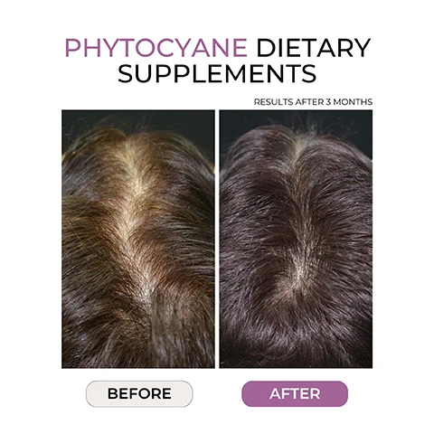 Image 1 - A comparison image showing a close-up view of a scalp before and after using Phytocyane dietary supplements, with visible text indicating BEFORE and AFTER beneath each image, and PHYTOCYANE DIETARY SUPPLEMENTS RESULTS AFTER 3 MONTHS at the top.
Image 2 - A woman with wavy brown hair is shown from the side, with the text 90% SLOWED DOWN HAIR THINNING* beneath her and additional text at the bottom about a clinical study on hair thinning.
Image 3 - A woman with long, dark hair pulls her hair back with one hand, displaying a graphic that states 95% STIMULATED GROWTH*, with additional text at the bottom detailing a clinical study.
Image 4 - A person is seen from behind with long, wavy hair, holding their hair back with both hands; the image features the text 90% INCREASED DENSITY* along with a note at the bottom about a clinical study.