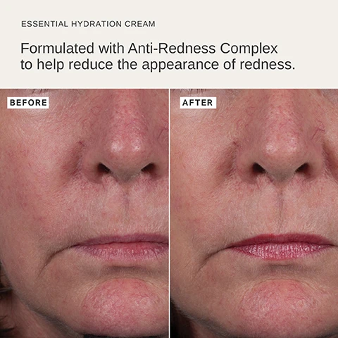 Image 1 - Image shows a close-up of a womans face divided into two halves, with the left labeled BEFORE displaying more redness around the nose and cheeks, and the right labeled AFTER showing reduced redness and smoother skin texture. Visible text reads ESSENTIAL HYDRATION CREAM and Formulated with Anti-Redness Complex to help reduce the appearance of redness.
Image 2 - A white tube of Alphatude Essential Hydration Cream with a creamy texture spread beside it, featuring text describing the benefits of the product: Anti-redness complex, Red algae extract, Palmitoyl tripeptide 5, and Ylang ylang + peppermint.
