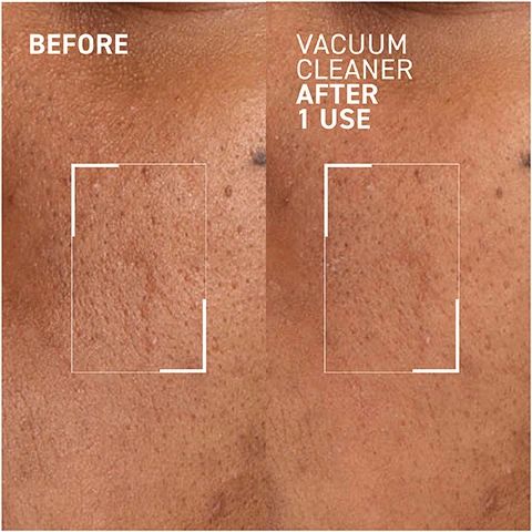 Image 1 - Image showing a side-by-side comparison of skin before and after using a vacuum cleaner, with the left labeled BEFORE and the right labeled VACUUM CLEANER AFTER 1 USE.
Image 2 - Before and after images of a persons nose demonstrating the effects of a vacuum cleaner, with the top labeled as Before and the bottom labeled as VACUUM CLEANER AFTER 1 USE.
Image 3 - A woman with a towel on her head is gently touching her cheek, showcasing a skincare product, with text that states 49% decrease in number of blackheads after 4 weeks* and Self assessment test conducted on 25 volunteers.
Image 4 - A circular dish contains a creamy blue and white swirl of product with text labels indicating Salicylic and Glycolic Acid further refine textural irregularities and Iris Extract helps clear pores preventing breakouts.
Image 5 - A tube of Dr. Brandt Vacuum Cleaner face mask stands on a light purple background, with droplets of product spilling beside it, and icons indicating the product is synthetic fragrance-free, paraben-free, sulfate-free, and cruelty-free.
