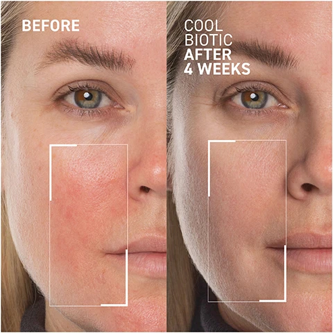 Image 1 - A split image showing a womans face with a noticeable difference in skin condition; the left side labeled Before shows redness and uneven texture, while the right side labeled COOL BIOTIC AFTER 4 WEEKS displays smoother and more even-toned skin.
Image 2 - A woman holds a jar of Dr. Brandt Cool Biotic moisturizer while gently touching her face, accompanied by text indicating that 97% reported the product visibly reduces redness and soothes skin after 2 weeks of use, with a note about the self-assessment evaluation conducted on 32 volunteers.
Image 3 - A side-by-side comparison of two thermographic images showing a persons profile; the left image is labeled Initial and the right image is labeled Immediately after, with the text Clinically tested to instantly soothe and hydrate sensitive skin at the top.
Image 4 - A circular dish contains a smooth, white cream with two marked dots, accompanied by text that reads CANNABIS SATIVA SEED OIL soothes and relieves skin while improving the skins barrier and BIOTIC BALANCING COMPLEX™ pre- and post-biotics balance skin microbiome.
Image 5 - A cream container labeled Dr. BRANDT Cool Biotic Prebiotic Redness Relief Cream sits against a soft green background, with icons indicating it is fragrance-free, paraben-free, cruelty-free, and sulfate-free.