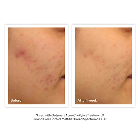 Image 1 - Image shows two side-by-side photos of a persons cheek: the left side labeled Before displays red acne marks, and the right side labeled After 1 week shows reduced redness and clearer skin; visible text at the bottom reads Used with Outsmart Acne Clarifying Treatment & Oil and Pore Control Mattifier Broad Spectrum SPF 45.
Image 2 - Image shows two types of cleansers on a light blue background: a Clarifying Cleanser, described as a foaming gel for balanced to oily, acne-prone skin, and a Clarifying Cream Cleanser, described as a non-foaming cream for balanced to dry, acne-prone skin, with the title Choose Your Cleanser above.
Image 3 - A tube of Murad Acne Control Clarifying Cleanser on a light blue background, with text stating 94% said it deeply cleanses skin, 97% said it dissolves excess oil, 88% said it improves skins overall appearance, and 85% said it leaves pores feeling clean of impurities.
Image 4 - A tube of Murad Clarifying Cleanser featuring a white body with blue accents, against a light blue background, with text indicating it contains two types of salicylic acid and green tea extract for clearer, healthier-looking skin.