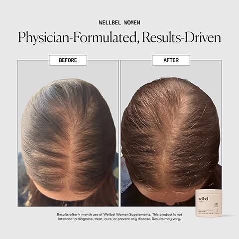 Image 10 - A promotional image displays three pink Wellbel Women supplement containers, along with the text Wellbel Women RESULTS-DRIVEN. PHYSICIAN-FORMULATED. AFTER 6 MONTH USE: 88% agree their hair appears longer.* 94% agree their hair appears healthier, overall.* 83% agree hair appeared fuller with new hair growth.* *in an independent consumer panel conducted by Wellbel, Inc. with 192 participants after 6 month use of Wellbel supplements wellbel. Image 11 - Three vertically stacked brown capsules are held by a black clamp-like object on a light grey background, next to text that reads WELLBEL WOMEN THE BENEFITS: + Balanced Dose of Biotin + Hair & Scalp Functionality + Thinning Hair Nourishment + Reduced Hair Shedding Care + Advanced Hair Growth Nutrition + Collagen Production Boost + Hormone Health Balance + Antioxidant Protection + Hair Vitality Support wellbel. Image 12 - A vertical clear tube containing many amber capsules in a spiral formation stands next to text describing expected results over four months: What To Expect Month 1+ Take 3 vegan capsules once daily and let your hair health journey begin. Consistency is key, and most people start to see visible results within 90 days. Month 2+ You may notice early improvements in hair strength, clearer skin, and faster-growing nails. Our formula is supporting your body from within. Month 3+ The foundation built over the last two months is now showing on the surface. Expect healthier strands, less shedding, and an overall improved look and feel. Month 4+ What was once new growth is now stronger, more resilient hair with sustained density. Youre not just seeing change; youre holding onto it. *These statements have not been evaluated by the Food and Drug Administration. This product is not intended to diagnose, treat, cure, or prevent any disease. Individual results may vary. Image 4 - A split image displays a before-and-after comparison of a persons scalp, with the left side showing noticeable hair thinning along the part line and the right side showing significantly increased hair density, and a light pink Wellbel Women product container is visible on the bottom right of the after image; the image also contains text that reads WELLBEL WOMEN Physician-Formulated, Results-Driven BEFORE AFTER Results after 4 month use of Wellbel Women Supplements. This product is not intended to diagnose, treat, cure, or prevent any disease. Results may vary. and on the product container, the text reads wellbel women HAIR SKIN + NAILS Beauty + Wellness, Backed By Science. DIETARY SUPPLEMENT VEGAN GLUTEN FREE NON-GMO 3 90 CAPSULES. Image 8 - A golden-brown powder is spread across a light grey background, with text overlaid that reads PHYSICIAN-FORMULATED Wellbel Women, FUNCTIONAL MEDICINE PHYSICIAN-FORMULATED + RESULTS-DRIVEN, + METHYLATED FOLATE + SAW PALMETTO + BETAINE HC1 + SELENIUM + BIOTIN + MSM, and the wellbel logo.