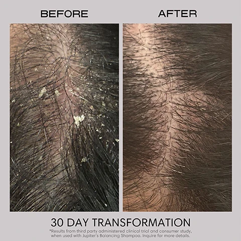 Image 2 - A split image displays a close-up of a scalp before and after treatment, showing severe dandruff and flakes on the left, and a much clearer scalp with healthy looking hair on the right, with the visible text BEFORE, AFTER, 30 DAY TRANSFORMATION, and *Results from third party administered clinical trial and consumer study, when used with Jupiters Balancing Shampoo. Inquire for more details. Image 3 - A product image lists four key ingredients and their benefits, with a pastel purple container holding a dollop of white cream on the right: Colloidal Oatmeal, Soothes dry scalp, while restoring the skin’s natural moisture; Green Tea Extract, Anti-aging ingredient that helps support healthy hair growth; Probiotics, Helps promote a balanced and healthy scalp microbiome; and Pataua Oil, Strengthens damaged hair and helps repair split ends. Image 4 - The image shows a hand with a dollop of white cream on a finger being dispensed from a pink bottle, with an orange label that says BEST SELLER, and text that reads How it works: Smoothes & softens hair, Gently detangles, Reduces hair breakage, Helps prevent split ends. Image 5 - A woman with wet, reddish-brown hair is shown from the side, with the text As featured in: ELLE VOGUE GQ allure TODAY The New York Times InStyle displayed above her. Image 6 - Alt text generation failed Image 7 - The image displays a side-by-side comparison of a previous white conditioner bottle design with a flip-top cap and a new light brown conditioner bottle design with a pump, alongside the text PREVIOUS Bottle Design NOURISHING CONDITIONER SMOOTHES & SOOTHES jupiter Moisturizing Formula with Probiotics, Vitamin E & Colloidal Oatmeal 9.5 fl oz | 280 ml, NEW Bottle Design JUPITER SCALP SOOTHING Nourishing Conditioner Pataua Oil, Probiotics & Vitamin E SULFATE-FREE COLOR-SAFE DERMATOLOGIST-TESTED Silky, soothing moisturizer that helps restore the scalps moisture barrier and promotes a healthy microbiome 14 FL OZ - 415 ML Where Science, and a bottom banner stating SAME FORMULA & BENEFITS, NEW LOOK Packaging may vary during brand transition.