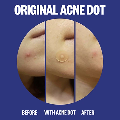 Image 1 - A three panel image shows a before, with acne dot, and after comparison of an acne spot on skin, with the text ORIGINAL ACNE DOT, BEFORE, WITH ACNE DOT, AFTER. Image 2 - A graphic on a yellow and blue background lists four ingredients and shows a box of Peace Out Acne Day & Night Duo patches with the text THE INGREDIENTS HYDROCOLLOID POLYMER TECHNOLOGY Extracts impurities & guards against external elements. ENCAPSULATED SALICYLIC ACID Penetrates pores to target blemishes & blackheads. RETINOL Helps promote clear-looking skin. ALOE VERA LEAF EXTRACT Soothes while minimizing the appearance of redness. PEACE OUT. ACNE DAY & NIGHT DUO ACNE DAY DOT 10 SHEER ACNE HEALING DOTS W/ ENCAPSULATED SALICYLIC ACID, RETINOL & ALOE VERA NET WEIGHT 23 g ACNE NIGHT DOTS 10 ACNE HEALING DOTS OPEN HERE. Image 3 - Comparison chart titled PICK YOUR PATCH comparing ACNE DAY DOT worn during the day under makeup, 61% thinner for virtually undetectable wear, and with specialized top layer that adheres makeup, to ACNE DOT worn at night while sleeping, thicker for more absorption, and lets you rock your skincare loud-n-proud, with text at the bottom indicating VISIBLE RESULTS IN 6HR OR LESS* *Based on Consumer Perception Study. Image 4 - Close-up of a face with acne blemishes and an acne patch applied, with a graphic and speech bubble pointing to the cheek area that says ACNE DAY DOT. Image 5 - Close up of a face with a finger pointing to a translucent patch on the cheek, with a speech bubble and smiley face icon saying ACNE HEALING DOT.