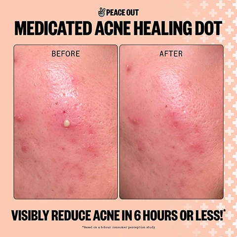 Image 1 - A before and after image shows a close-up of skin with a large inflamed acne spot before treatment and the same area with reduced redness and inflammation after treatment, with text Peace Out Medicated Acne Healing Dot Before After Visibly Reduce Acne In 6 Hours Or Less! *Based on a 6-hour consumer perception study. Image 2 - A split image shows skin before and after acne treatment with visible red spots in the before section and fewer spots in the after section including the text BEFORE, AFTER, AFTER 1 USE and AFTER 6 HOURS. Image 3 - The image shows information about the ingredients for acne patches, listing Hydrocolloid Polymer Technology, Encapsulated Salicylic Acid, Retinol, and Aloe Vera Leaf Extract with descriptions of their benefits, next to a box labeled Peace Out Acne 20 Acne Healing Dots 2 x 10 Dot Pouches wi Salicylic Acid, Retinol & Aloe Vera. Image 4 - Close-up of a face with round skin patches applied, alongside a stopwatch showing 6 HR and text that reads VISIBLE RESULTS IN 6 HOURS OR LESS* *Based on a Consumer Perception Study. Image 5 - An image shows two pimple patches, one large circular patch and one smaller patch placed on a fingertip, with text listing product features: PATENTED ACNE FIGHTING PIMPLE PATCH WHAT MAKES US SPECIAL CLEAN PETROLEUM-FREE HYDROCOLLOID SALICYLIC ACID RETINOL ALOE VERA PATENTED TECHNOLOGY BIODEGRADABLE *Patches may vary in appearance due to active ingredients.