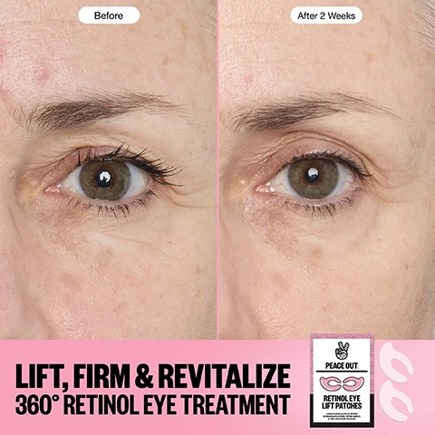 Image 1 - A split image shows a persons eye area before and after 2 weeks with text that reads Before After 2 Weeks LIFT, FIRM & REVITALIZE 360° RETINOL EYE TREATMENT PEACE OUT RETINOL EYE LIFT PATCHES 6 PAIRS OF BIOCELLULOSE EYE PATCHES W/ ENCAPSULATED RETINOL, PEPTIDE COMPLEX & TRIPLE HYALURONIC ACID BLEND. Image 2 - A split image shows a persons eye area before treatment on top and after 2 weeks of treatment on the bottom, with fewer wrinkles visible in the after photo, also showing a product box and eye patches with text that reads Before, After 2 Weeks, LIFT, FIRM & REVITALIZE 360° RETINOL EYE TREATMENT, PEACE OUT. RETINOL EYE LIFT PATCHES 6 PAIRS OF BIOCELLULOSE EYE PATCHES W/ ENCAPSULATED RETINOL, PEPTIDE COMPLEX & TRIPLE HYALURONIC ACID BLEND. Image 3 - A before and after image showing a persons eye area with reduced wrinkles after 2 weeks, with text Before, After 2 Weeks, LIFT, FIRM & REVITALIZE 360° RETINOL EYE TREATMENT, PEACE OUT., RETINOL EYE LIFT PATCHES, and 6 PAIRS OF BIOCELLULOSE EYE PATCHES W/ ENCAPSULATED RETINOL, PEPTIDE COMPLEX & TRIPLE HYALURONIC ACID BLEND. Image 4 - A light pink eye patch on a pink background with the text LIFT, FIRM & REVITALIZE YOUR EYES WHAT MAKES ME SPECIAL TARGETS & TREATS THE ENTIRE EYE AREA 360° THE ONLY BIOCELLULOSE INFUSED WITH ENCAPSULATED RETINOL COMFORTABLE AND NON-IRRITATING FITS ALL EYE SHAPES & STAYS IN PLACE BIODEGRADABLE PATCHES & LINERS. Image 5 - An image displays instructions on a pink background with the text HOW TO USE 1. CLEANSE SKIN & DISCARD PINK PROTECTIVE LINERS FROM BOTH SIDES OF THE PATCHES 2. ADJUST THE PATCHES ON DRY SKIN TO FIT COMFORTABLY ON YOUR EYELIDS & UNDER EYE 3. REMOVE AFTER 15 MINS. DO NOT RINSE, PAT EXCESS SERUM INTO SKIN. A TARGETED TREATMENT TO LIFT, FIRM & REVITALIZE YOUR FULL EYE AREA!