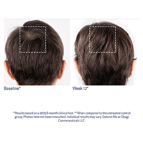 Image 1 - Image shows a before-and-after comparison of a persons scalp viewed from the back, with a dashed square highlighting an area of hair loss at Baseline* on the left, and showing increased hair density in the same highlighted area at Week 12* on the right, with additional text below stating *Results based on a 2025 6-month clinical test. **When compared to the untreated control group. Photos have not been retouched. Individual results may vary. Data on file at Obagi Cosmeceuticals LLC. Image 2 - A two-panel image shows a before and after comparison of hair growth on a persons temple area, with the left panel labeled Baseline depicting sparser hair and the right panel labeled Week 12 showing significantly denser hair, both panels feature a dashed white square highlighting the hair area, and accompanying text reads *Results based on a 20-25 6-month clinical test. **When compared to the untreated control group. Photos have not been retouched. Individual results may vary. Data on file at Obagi Cosmeceuticals LLC. Image 3 - Two images show a before and after comparison of a persons scalp, with the first image, labeled Baseline*, revealing sparser hair and the second image, labeled Week 12*, showing visibly thicker hair; the supporting text reads: *Results based on a 2025 6-month clinical test. **When compared to the untreated control group. Photos have not been retouched. Individual results may vary. Data on file at Obagi Cosmeceuticals LLC. Image 4 - A before and after image comparison shows a womans temple area with sparser hair at baseline on the left, and visibly increased hair density after 12 weeks on the right, with text Baseline*, Week 12*, and *Results based on a 2025 6-month clinical test. **When compared to the untreated control group. Photos have not been retouched. Individual results may vary. Data on file at Obagi Cosmeceuticals LLC. Image 5 - Two images show the back of a head with dark curly hair, illustrating hair growth progression: the left image, labeled Baseline, shows a noticeable bald spot within a dashed square, while the right image, labeled Week 12, shows significant hair regrowth in that same area; visible text below the images reads Results based on a 2025 6-month clinical test. When compared to the untreated control group. Photos have not been retouched. Individual results may vary. Data on file at Obagi Cosmeceuticals LLC.