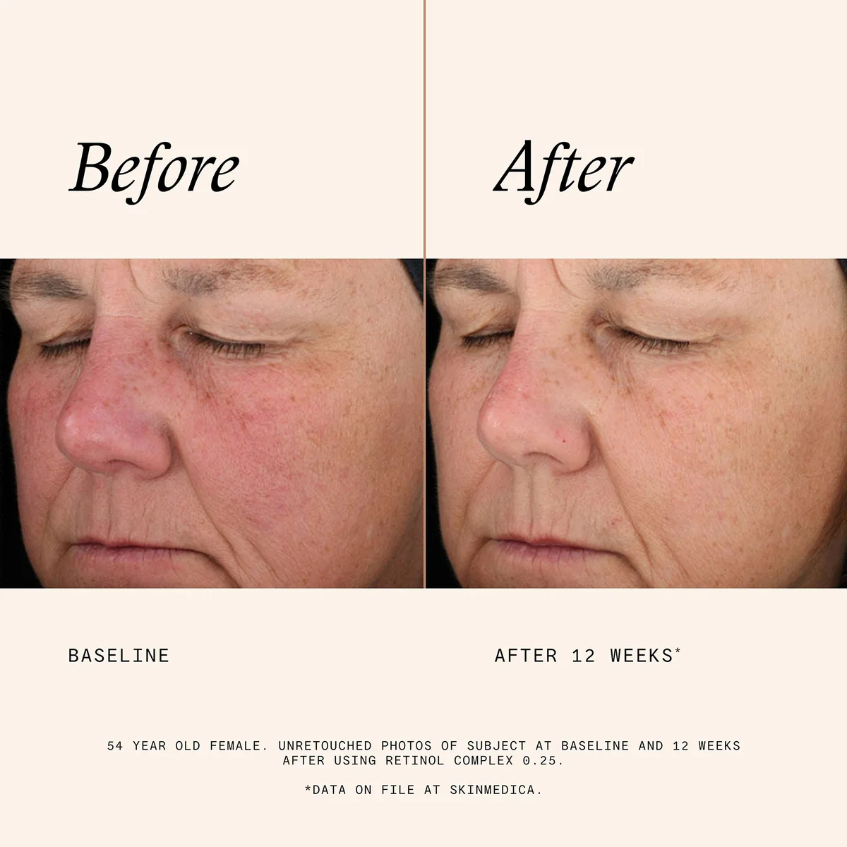 SkinMedica Age Defense Retinol Complex .25 (1 fl. oz.)