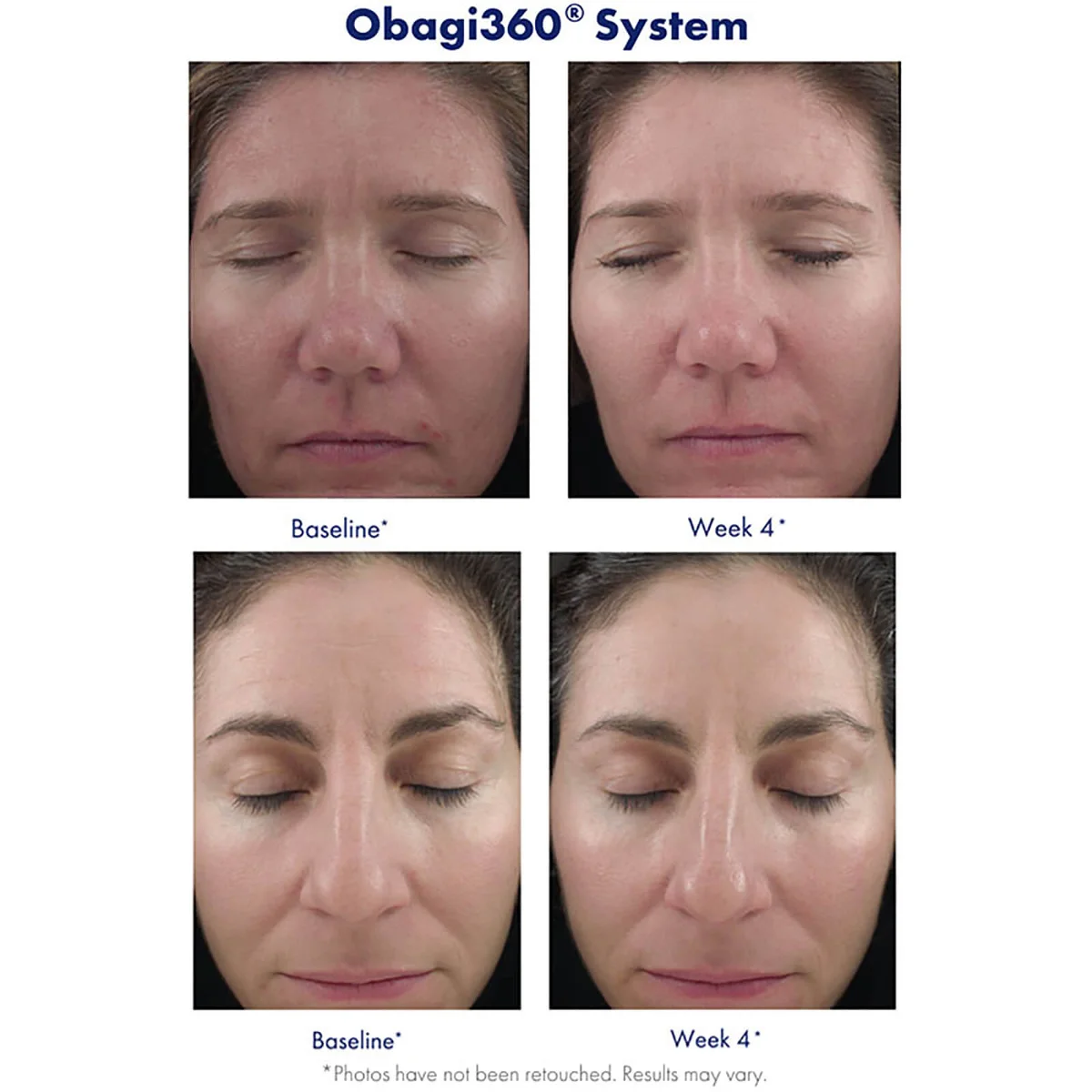 Obagi Medical Retinol 1.0 (1 oz.)