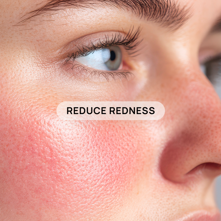 Rosacea, irritation
and more.